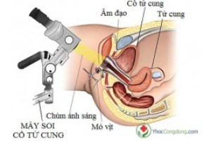 Soi cổ tử cung